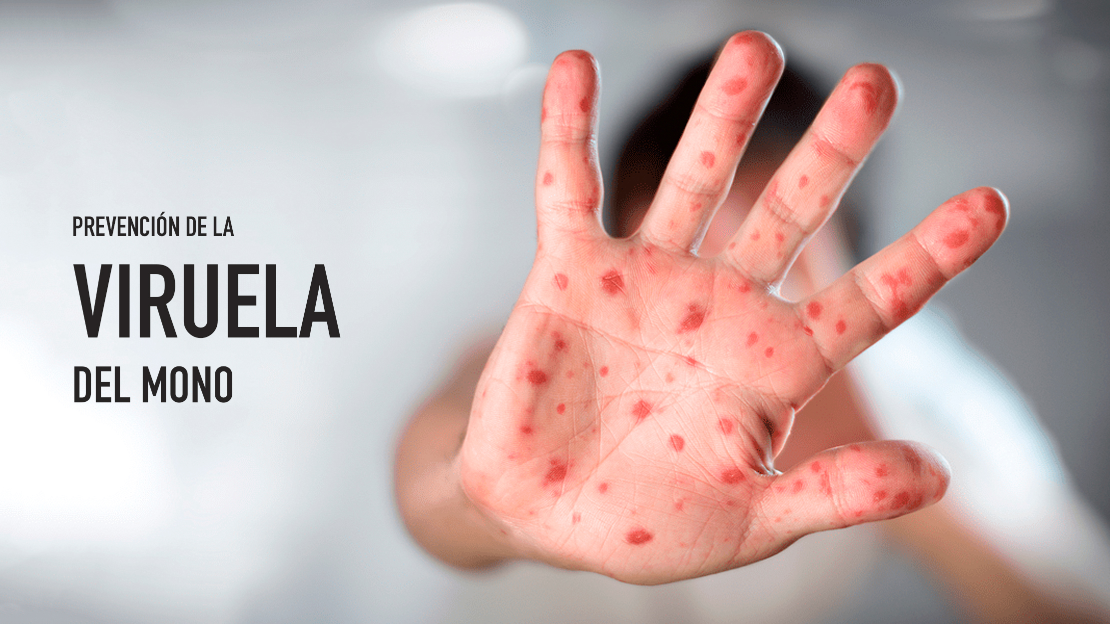 Como a Higiene e a Desinfec&ccedil;&atilde;o S&atilde;o Essenciais para Evitar a Var&iacute;ola dos Macacos
